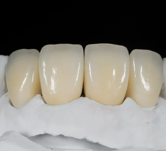 Full Zirconia Crown