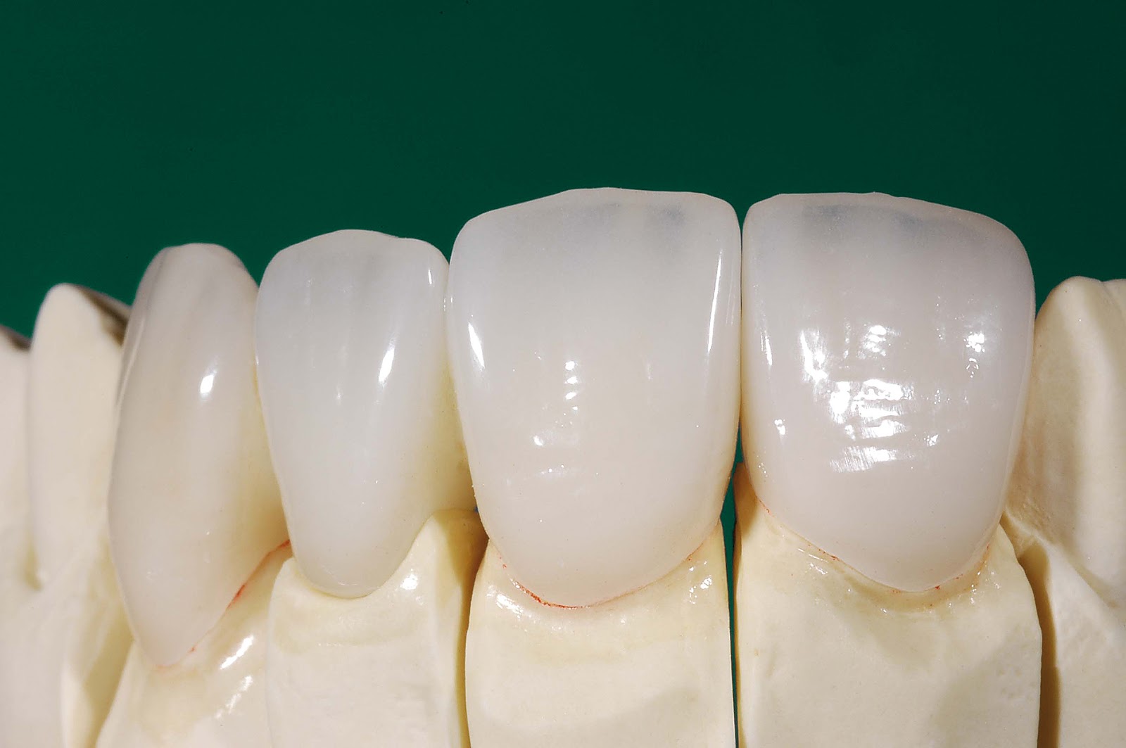 Zirconia Crown E-Max