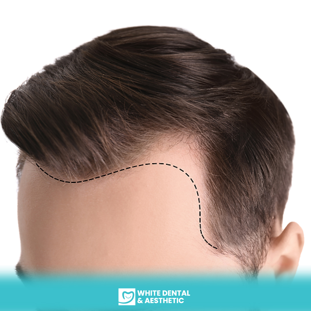 Hair Transplants and Treatment