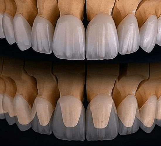 Composite Veneers