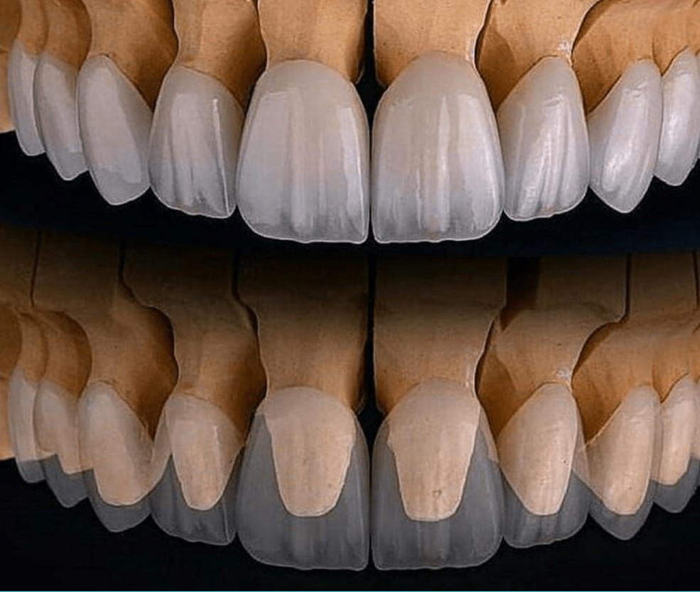 Composite Veneers