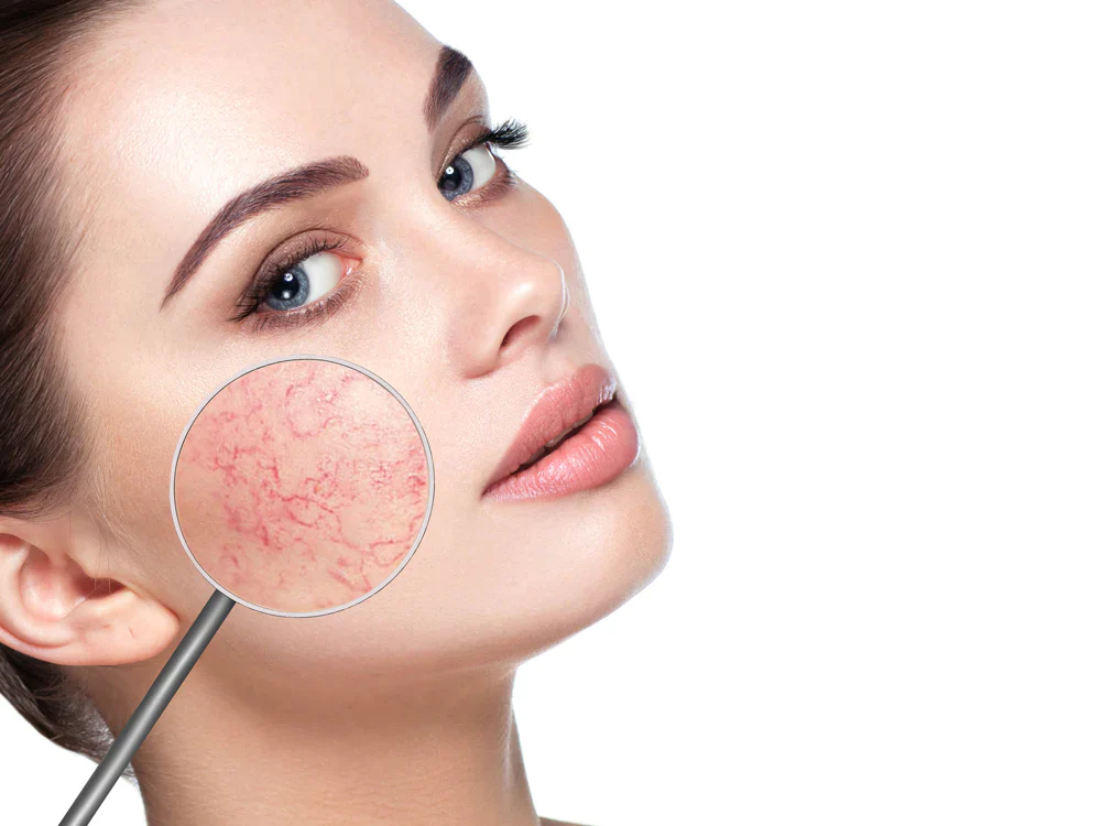 Rosacea  Treatment